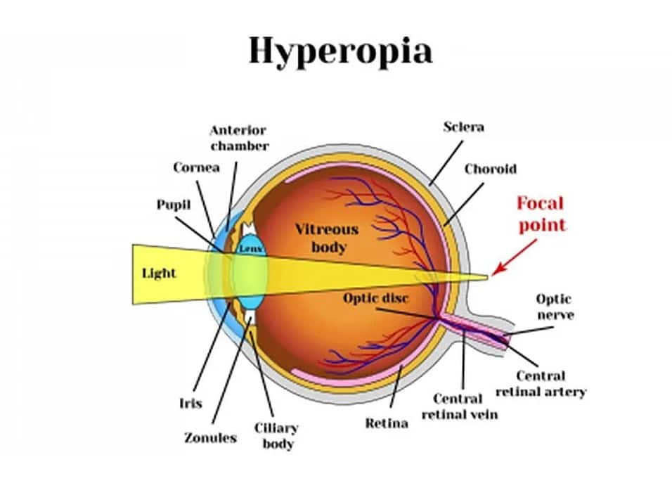 hyperopia